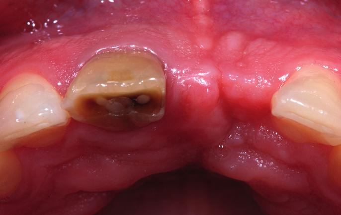 At the same time, tooth 11 was prepared for a crown and fitted with a direct MDT Andreas Graf temporary.