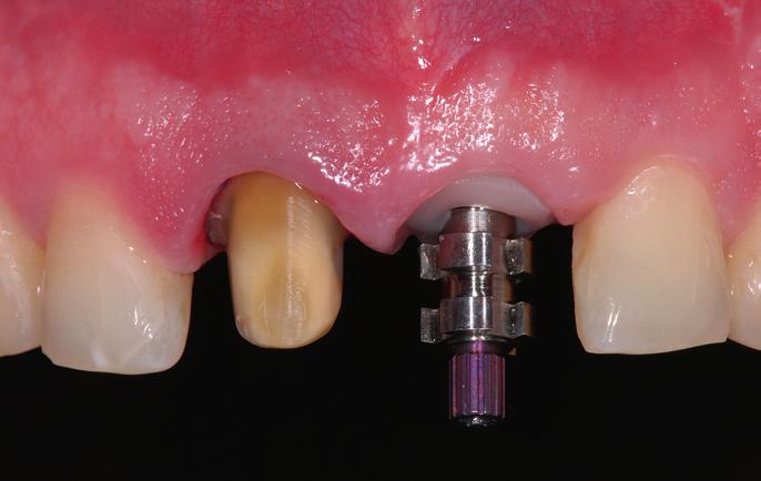 Using a silicon index of the wax-up, the frameworks for crown 11 and the directly screwed