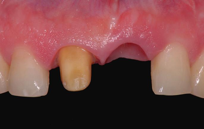 These data were then sent via the Internet to the milling Removable Prosthodontics and