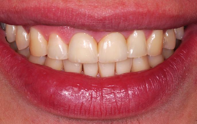 The soft tissue in region 21 was similar to the rest of the gingiva