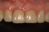 Treatment outcome and conclusion The excellent biologic and esthetic results can be appreciated in the 6-month recall and radiograph (Figs 11 and 12).