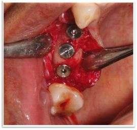 The impression copings of 45 and 46 were removed due to limited mouth opening and placement of 4.2 x 10 mm implant in 47 region was done (Figure 3).
