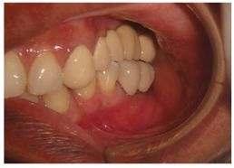maintaining oral hygiene and recalled after 6 months for follow up. Patient was happy with the functional outcome of the prosthesis.