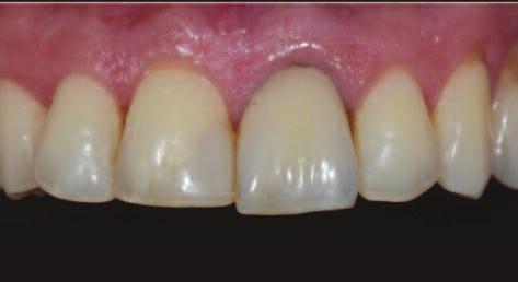 Report Figure 1: Preoperative situation, note the unaligned incisive edge of tooth 21 with the grey cervical lining.