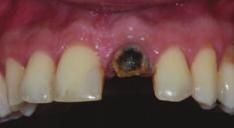 Figure 3: After conservative extraction of tooth 21, collagen membrane is placed inside the bony envelope.