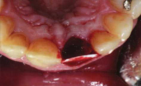 Figure 4: Xenograft (Bio Oss ) is placed inside the socket, covered by a collagen membrane sutured to the palatal