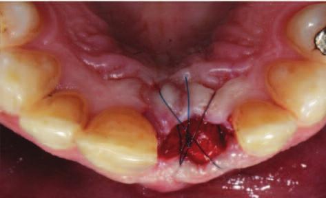Figure 5: A temporary Maryland bridge is prepared in order to facilitate the healing of soft tissues and enhance