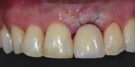 It was noted that since resorption of bone ridge is faster during the first six months following extraction, 5 a