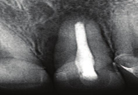 Figure 8: Periapical radiograph showing the resorbed apex of tooth 21.
