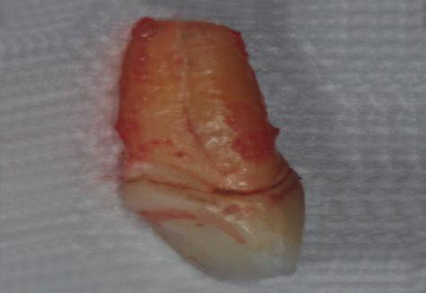 Figure 11: Periapical radiograph showing the xenograft in place in socket of tooth 21.