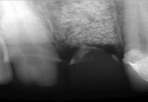 The tooth was deemed hopeless and referred for extraction with socket preservation for future dental implant placement.
