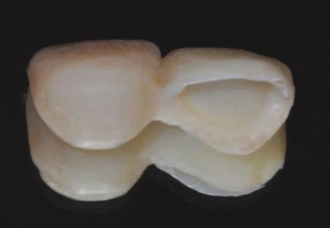 Figure 12: Temporary crowns prepared in order to facilitate the healing of the surrounding tissues.