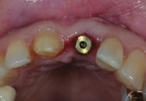 Figure 14: Temporary crowns placed on tooth 11 and a single piece, direct-to-fixture provisional screw-retained restoration on site 21 to facilitate the healing process.
