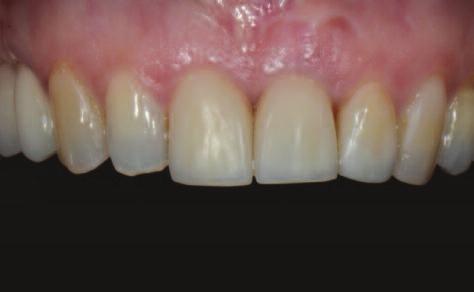 4 Loss of vertical ridge height will also occur less than horizontal width, reducing the buccal bone aspect of the bony ridge.