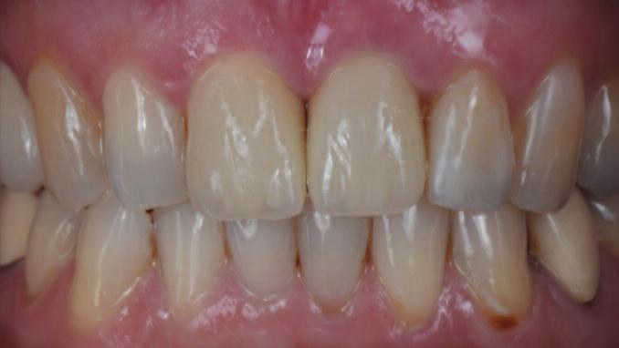 Figure 19: Clinical presentation of the final esthetic result with the healthy surrounding soft tissues. The clinical crowns conserved the gingival architecture and met the patient s esthetic demands.