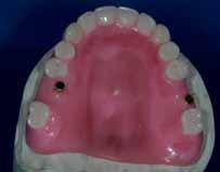 4 5 Develop a Screw Retained Occlusion Rim Figure 4: Upon confirmation of cast
