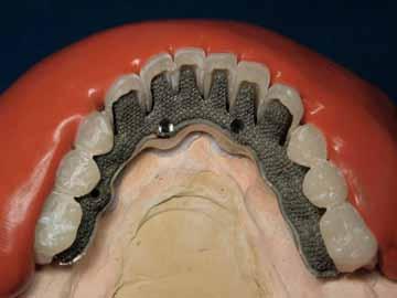 Figure 7: For a fixed detachable prosthesis, transfer prosthetic teeth to fixed