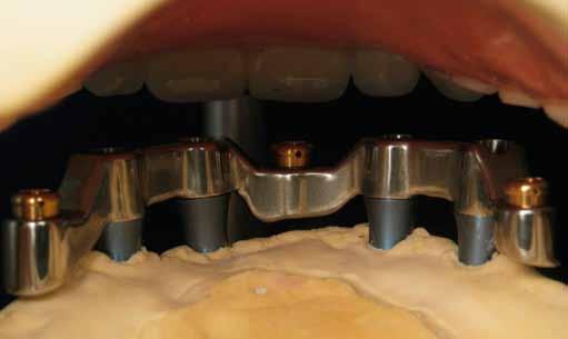 A wide variety of designs are available for implant bar supported removable overdentures.