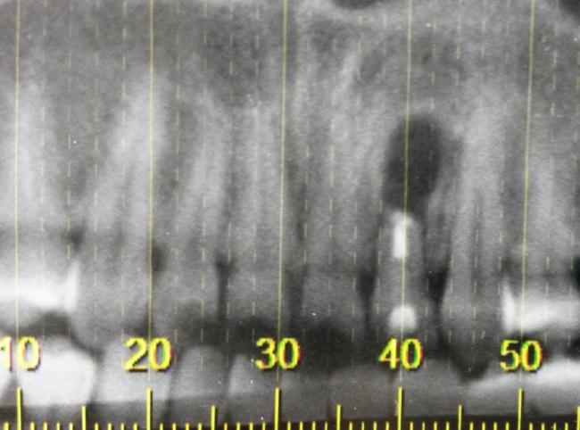 Periapical and CBCT scan slice radiographic