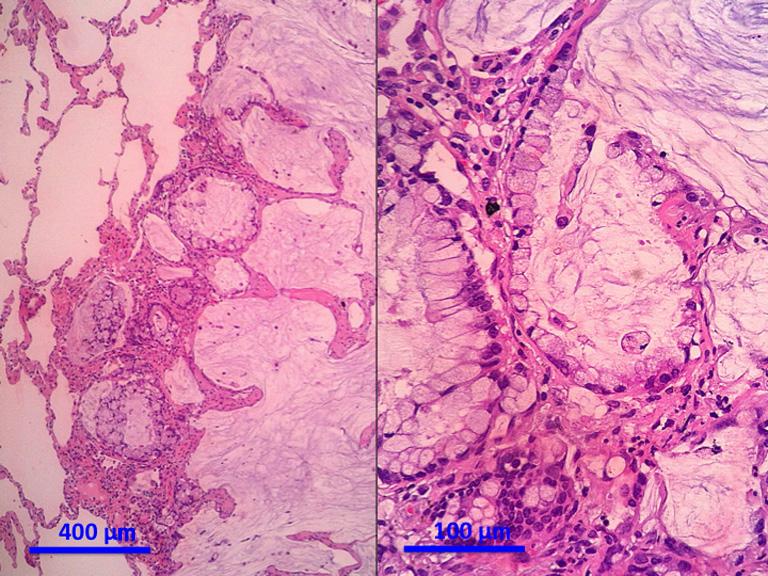 Invasive adenocarcinoma Lepidic predominant (formerly nonmucinous BAC with >5 mm invasion) A B Acinar predominant Papillary predominant Micropapillary predominant Solid predominant with mucin