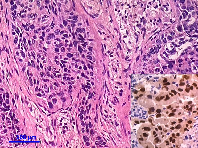 Journal of Thoracic Disease, Vol 6, Suppl 5 October 2014 S565 Figure 5 Solid type adenocarcinoma. TTF-1 positivity is disclosed in bottom right.