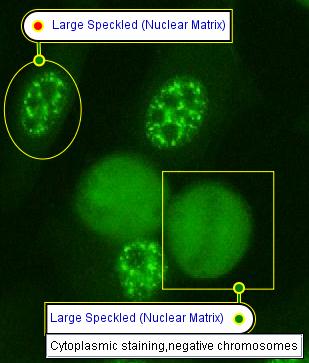 speckled nucleoplasmic