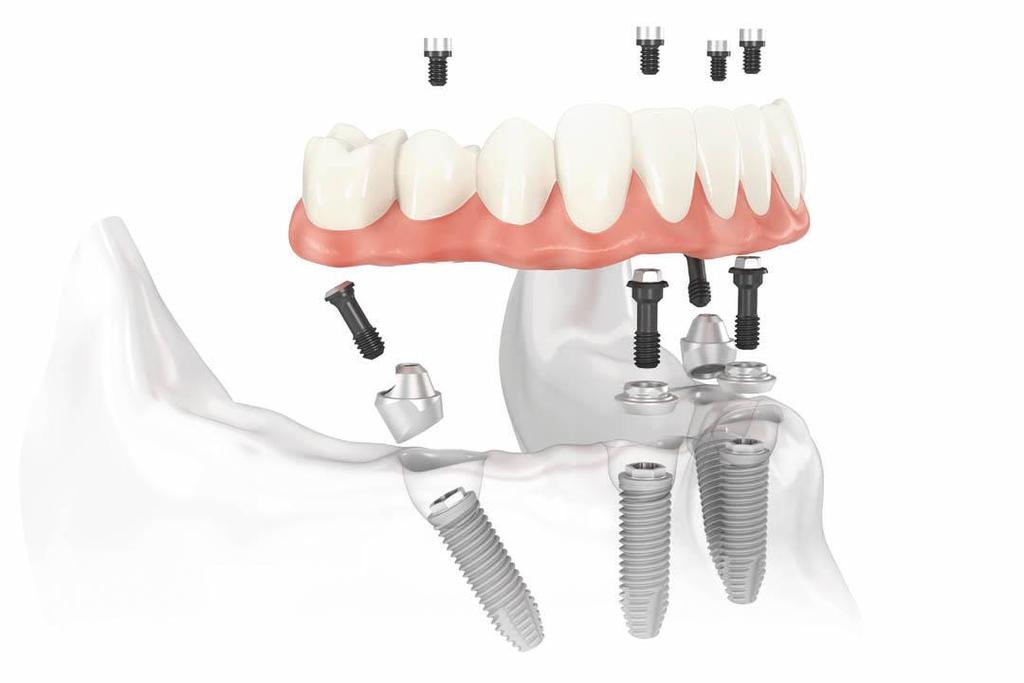 Introduction to All-on-4 Principle Four implants (two straight implants in the anterior and two angled implants in the posterior) supporting a provisional, fixed and immediately loaded