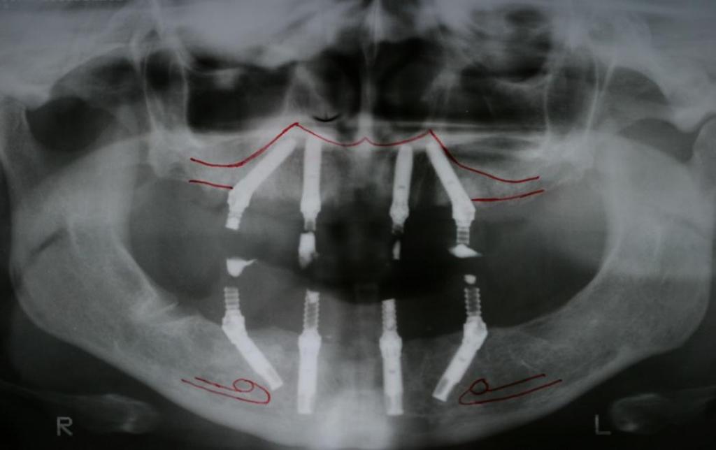 All-on-4 Benefits Benefits of Angled posterior implants: Help avoid relevant