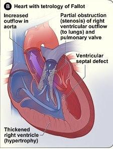 Diagnose the etiology of heart disease Right to left shunt: causing pulmonary hypoperfusion.