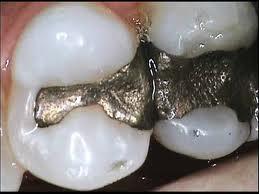 Disposal of Hazardous Materials Extracted teeth