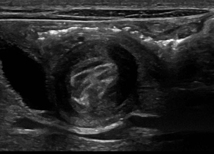 Sonographic Signs of Pyloric Stenosis: Target sign Peripheral ring of