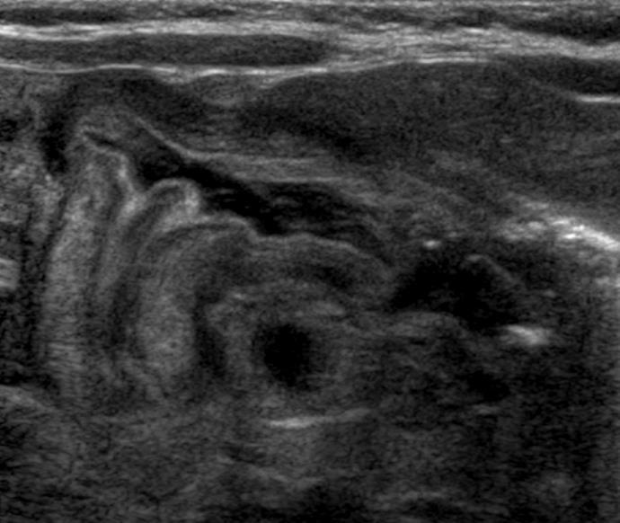 Sonographic Signs of Pyloric Stenosis: Antral nipple sign