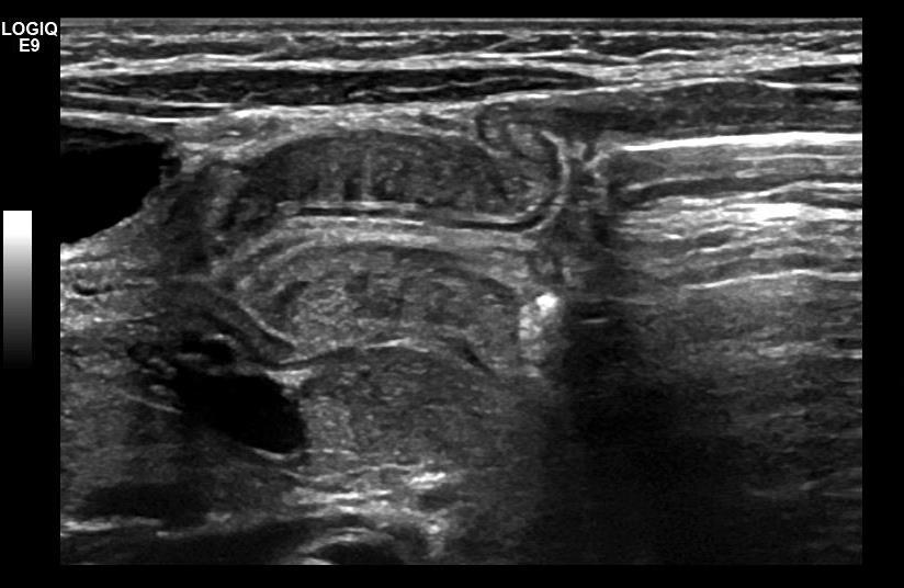 Sonographic Signs of Pyloric Stenosis: Cervix sign - Extension of hypertrophied pyloric
