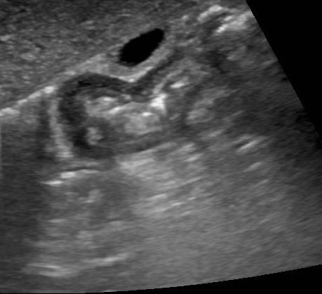 Ultrasound: Pyloric muscle thickness