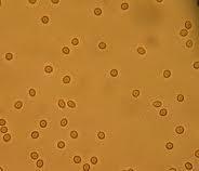 Microscopic Hematuria 10 potential donors with micro hematuria were biopsied 1 IGAN, 4 Thin BM disease,