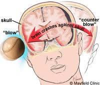 Focal TBI: Contusions and Lacerations Coup Contrecoup Injury A blow to the head causes the initial contusion