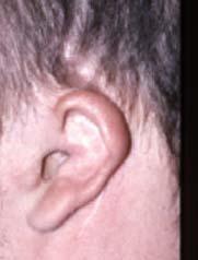 Microtia may occur with or without artresia (the closing or absence of an ear canal). Many children who have microtia have a normally formed inner ear.