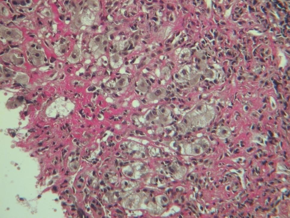 Autoimmune Hepatitis - Lobular inflammation Lobular inflammation in AIH Typically plasma cell rich
