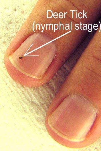 Lyme Disease Prophylaxis Consider prophylaxis if: Ixodes tick engorged and on for over 36 hours Prophylaxis given within 72 hours of tick bite Ecological information states that percentage of ticks