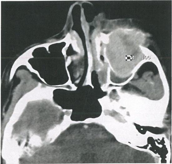 Fig-3: Primaryextracranial meningioma involving left maxillary sinus Axial and coronal contrast enhanced CT images in soft window settings show an ill-defined, homogenously enhancing mass lesion in