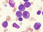 Myelogenous Leukemia