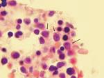 Leukemia (M7) Acute