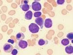(ALL)  Leukemia (M4e) 