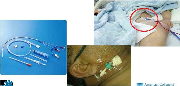 Central Venous Catheters 16 Central Venous Catheters Mainly used in air medical services and rarely ground EMS Complications: Infection Arterial cannulation Pneumothorax (if subclavian or IJ) No wide