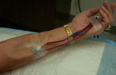 Anchoring of Dialysis Needles and Lines Assume patient will move arm significantly during treatment No anchoring to