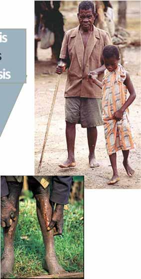 NEGLECTED TROPICAL DISEASES Dengue Leprosy Yaws Rabies Trachoma HAT ChagasDisease STH BuruliUlcer