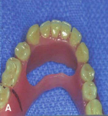 Inclusion criteria were: 1) agreement to have existing dentures remade prior to surgery if worn longer than 5 years or if they were made with porcelain teeth; 2) placement of implants 10 mm or longer