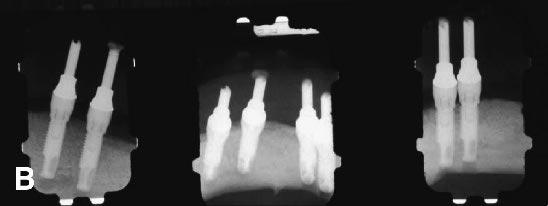 These radiographs were considered baseline. Laboratory screws were hand tightened, and the occlusal openings were closed with temporary material.