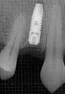 and lateral view; c) Periapical radiograph; d) CT dental scan.