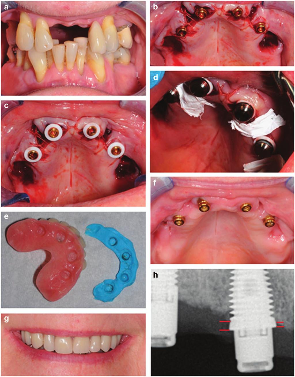2 Figure 1. (a) A 64-year-old female, with defective maxillary dentition received four immediately placed implants simultaneously with extractions using (b) four implants were installed (3 11.